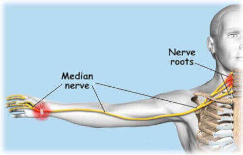 Pinched nerve deals arm pain